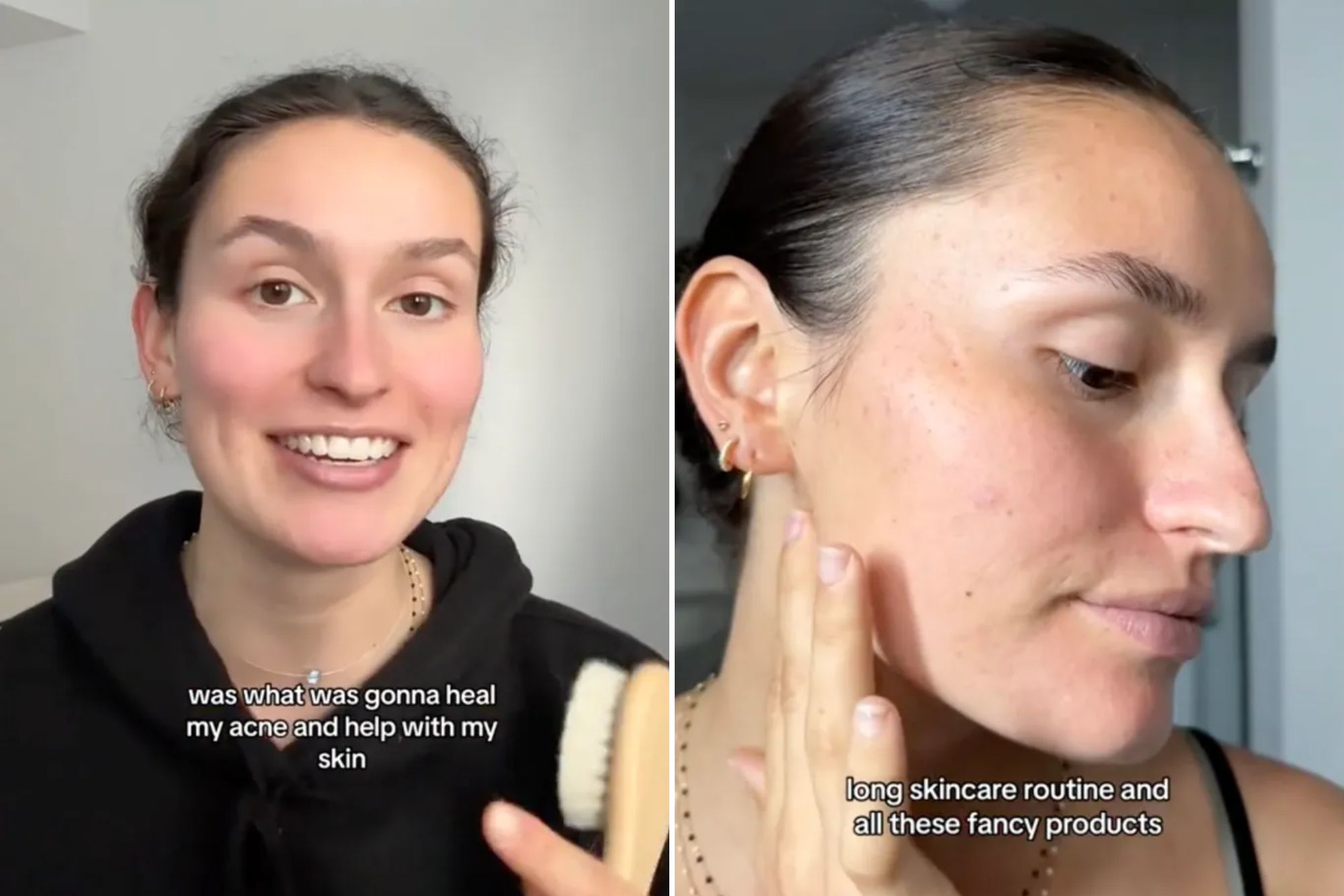 This is the shocking way I cleared up my acne for good— but haters say I’m ‘dirty’